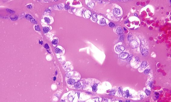 FIGURE 25.25, The nuclear features are well demonstrated in this macrofollicular variant of papillary carcinoma. A crystalloid is seen in the center. Nuclear grooves, nuclear contour irregularities, and nuclear chromatin clearing is accentuated.