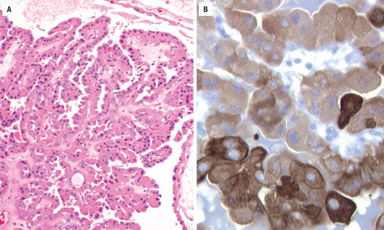 FIGURE 25.27, ( A ) Oncocytic cells within a papillary architecture. Note that the nuclei are luminal. ( B ) CK19 is known to be positive in the oncocytic variant of PTC but is not specific or sensitive.
