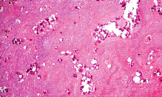 FIGURE 25.29, A low magnification demonstrating innumerable psammoma bodies in clusters with lymphocytic thyroiditis. Many of the psammoma bodies are in lymph-vascular spaces.