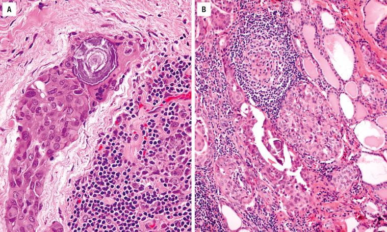 FIGURE 25.31, ( A ) Papillary carcinoma with squamous metaplasia associated with a psammoma body. There is lymphocytic thyroiditis. ( B ) Psammoma bodies and papillary carcinoma are noted within a lymph-vascular channel. There is well developed lymphocytic thyroiditis and fibrosis.