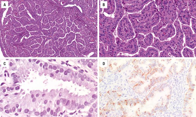 FIGURE 25.32, Various patterns seen in tall cell variant of papillary thyroid carcinoma. ( A ) No colloid is seen with elongated follicles creating the papillary projections. ( B ) The cells are each at least three times taller than they are wide with prominent cellular borders. ( C ) The cytoplasm ranges from oncocytic, amphophilic, basophilic, and clear. Intranuclear cytoplasmic inclusions are common. ( D ) The neoplastic cells are highlighted with napsin.