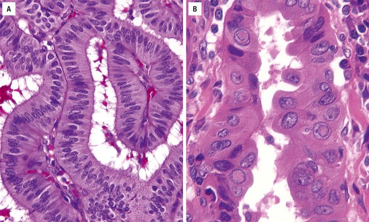 FIGURE 25.33, ( A ) Columnar variant with pseudostratification of nuclei with no colloid present. ( B ) Tall cell variant with oncocytic cells, intranuclear cytoplasmic inclusions, and cells three times as tall as they are wide.