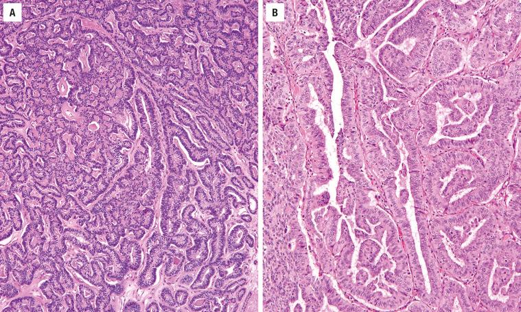 FIGURE 25.34, Columnar cell variant of PTC. ( A ) Papillary structures arranged in markedly elongated, parallel follicles (tram-tracks). There is scant colloid, with marked nuclear stratification ( B ).