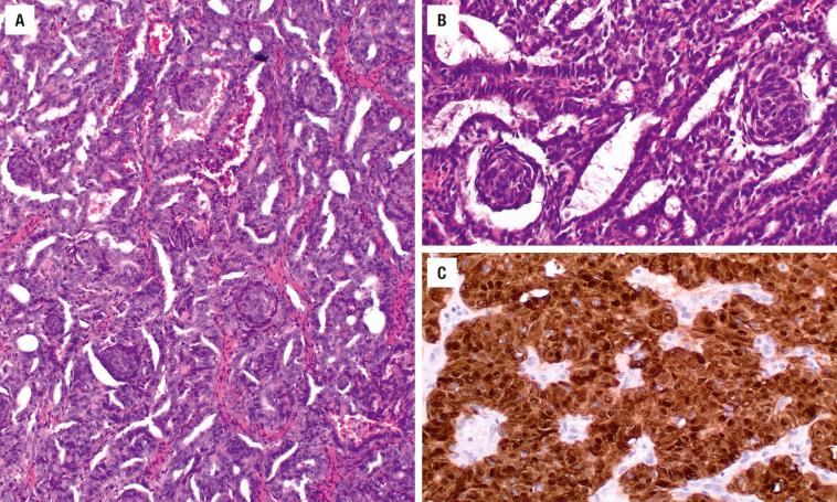 FIGURE 25.38, ( A ) There is a cribriform to elongated pattern to this cribriform morular variant, with numerous squamous morules easily identified in a background that lacks colloid. ( B ) The squamous morules are whorls, juxtaposed to the elongated and partially stratified nuclei. ( C ) There is a strong nuclear expression of β-catenin.