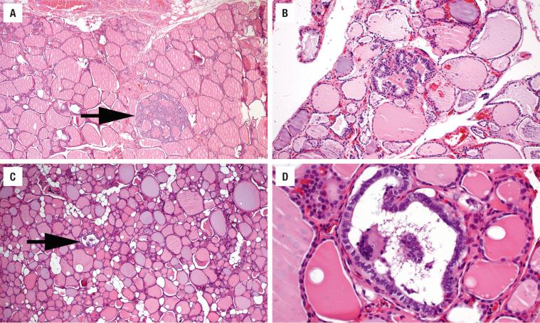 FIGURE 25.39, (A-D) Microscopic papillary carcinomas are distinct from the surrounding tissue and have both papillary architecture and show typical nuclear features. The tumors are frequently only a few follicles large. C is a low-power magnification, whereas D is a high power of the same tumor.