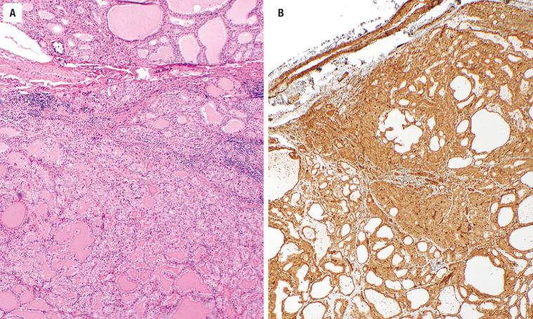 FIGURE 25.40, This thyroid gland neoplasm is surrounded by a very thin and delicate capsule (A) , showing a strong PTEN immunohistochemistry reaction (B) .