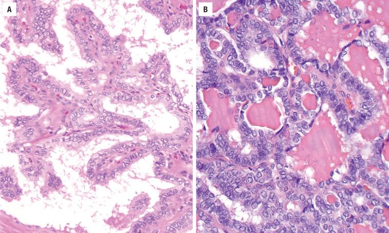 FIGURE 25.5, ( A ) Delicate and complex papillary fronds lined by cells with an increased nuclear-to-cytoplasmic ratio, disorganized placement of the nuclei within the cell, and nuclear crowding and overlap. ( B ) Nuclear overlapping and crowding with isolated papillae are seen.