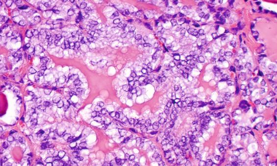 FIGURE 25.7, There is nuclear crowding and overlapping within hypereosinophilic colloid that shows peripheral scalloping. There is well-developed nuclear chromatin clearing (optical clearing: Orphan Annie nuclei).