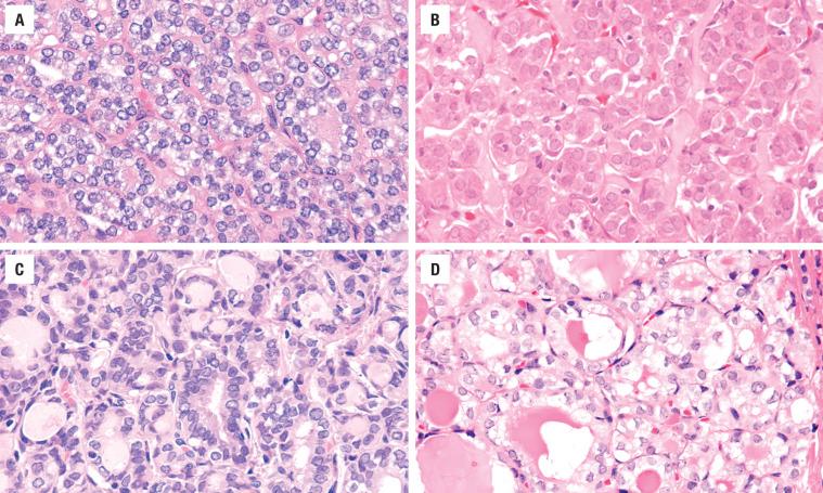 FIGURE 25.8, Cytomorphologic features in PTC. ( A ) Nuclear crowding and chromatin clearing. ( B ) Fine, ground glass nuclear chromatin. ( C ) Nuclear overlapping, chromatin irregularities, and loss of nuclear polarity. ( D ) Pale nuclear chromatin in irregular nuclei surrounding follicles with scalloped, dense colloid.