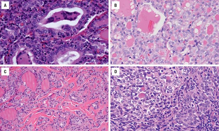 FIGURE 25.9, Associated findings in PTC. ( A ) Giant cells within the colloid. ( B ) Crystals within the colloid. Nucleoli are noted along the nuclear membrane. ( C ) Dense fibrosis separating the tumor cells. ( D ) Squamous metaplasia (lower right corner) within a PTC.