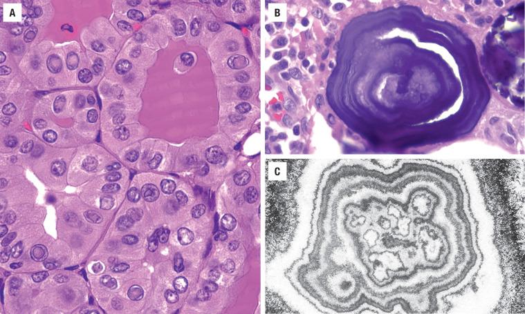 FIGURE 25.10, ( A ) Multiple intranuclear cytoplasmic inclusions contain material the same color as the cytoplasm. ( B ) Light microscopic appearance of a psammoma body with concentric laminations. ( C ) Electron micrograph of a psammoma body showing concentric lamination and crenated nuclei in the center.