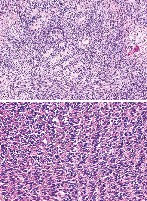 Fig. 27.12, A and B, Nuclear palisading is an uncommon feature in MPNST. It may also be seen in schwannomas and some leiomyosarcomas.