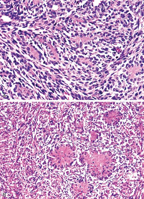 Fig. 27.13, Hyalinized cords ( A ) and nodules ( B ) are uncommon but distinctive features of MPNSTs.