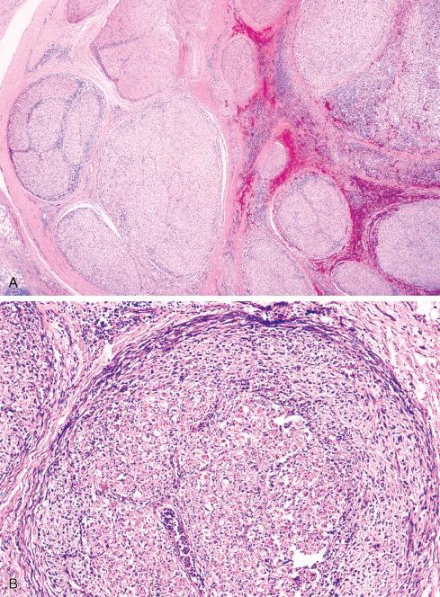 Fig. 27.14, A, Replacement of peripheral nerve by MPNST. B, High-power view showing insinuation of tumor between nerve fascicles.