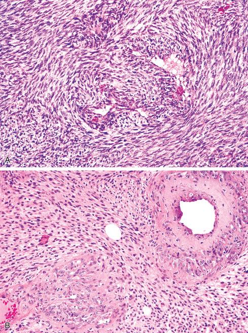 Fig. 27.15, Peculiar changes around small vessels in MPNST. A, Tumor appears to herniate into lumens of vessels, whereas in B, proliferation of small vessels is seen in walls of large vessels in MPNST.