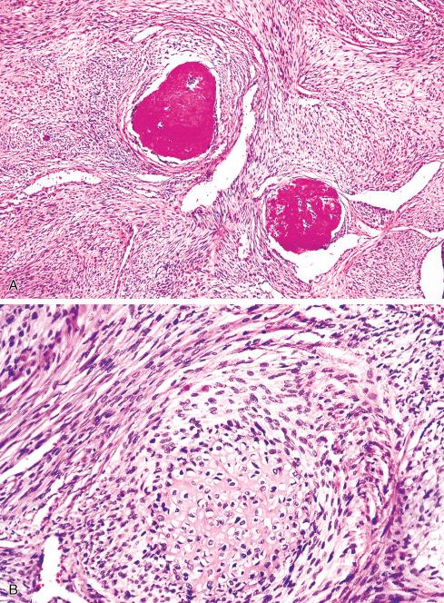 Fig. 27.16, Heterologous elements in MPNST are most often bone ( A ) and cartilage ( B ).