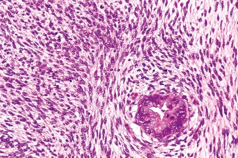 Fig. 27.20, MPNST with glandular differentiation. Glands appear malignant in this case.