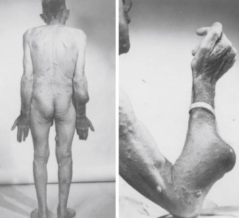 Fig. 27.2, MPNST of arm in patient with long-standing neurofibromatosis.