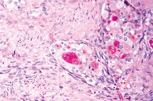 Fig. 27.21, Glands in MPNST containing carminophilic mucin.