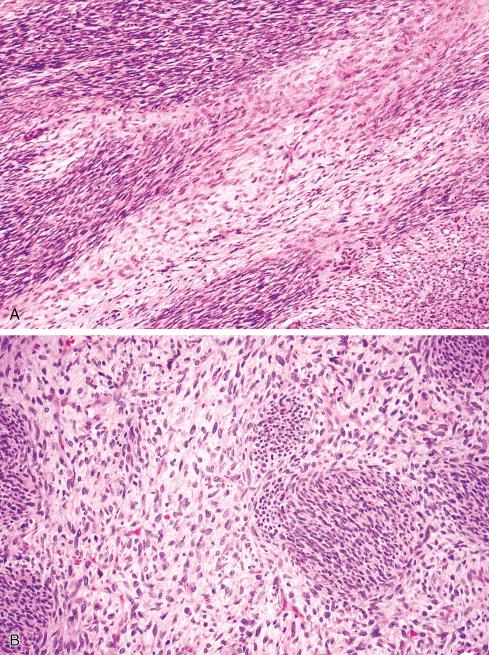 Fig. 27.3, A and B, Typical appearance of MPNST with densely cellular areas alternating with less cellular areas, creating a marbleized appearance.