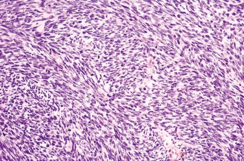 Fig. 27.4, MPNST consisting exclusively of dense fascicles of spindled cells, similar to fibrosarcoma.