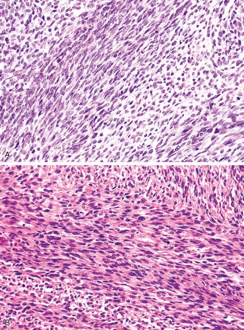 Fig. 27.5, A and B, Cellular fascicles of MPNST.