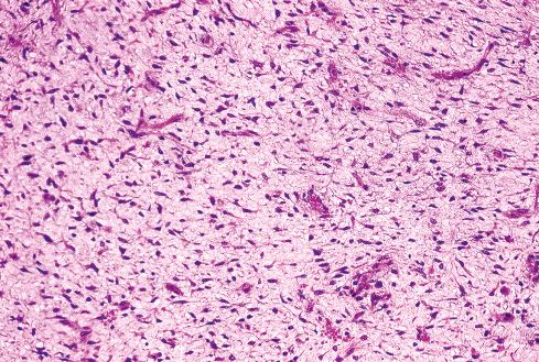 Fig. 27.6, Myxoid area in MPNST showing randomly arranged Schwann cells.