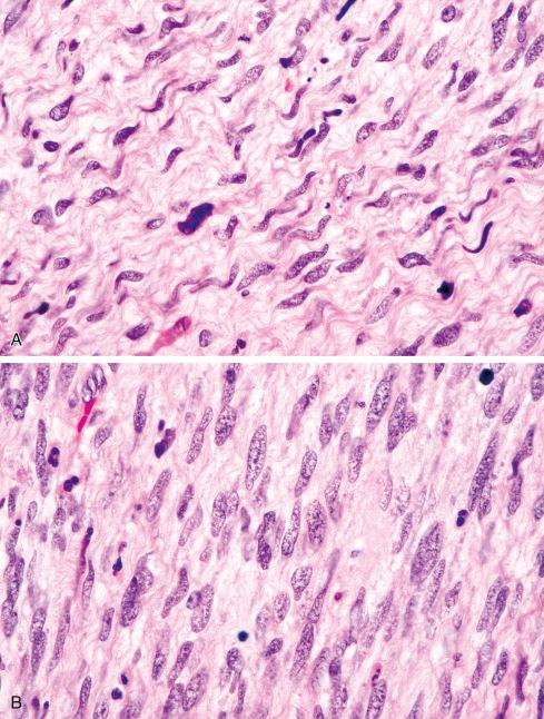 Fig. 27.7, Cells in MPNST with well-differentiated areas where cells have an irregular, buckled shape characteristic of Schwann cells ( A ), to less differentiated areas where cells bear less resemblance to Schwann cells ( B ).