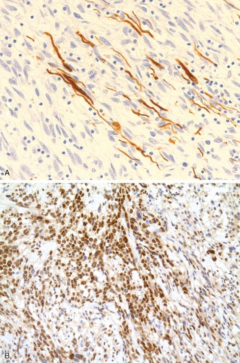 Fig. 27.8, A, S-100 protein immunostain in MPNST typically highlights only a few cells or is often negative altogether. B, SOX10 immunostain of MPNST showing nuclear staining of a significant number of cells.