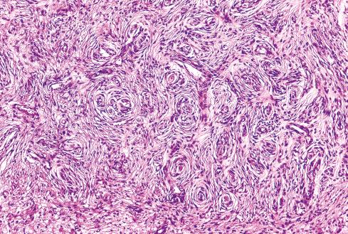 Fig. 27.10, Low-grade MPNST with curlicue arrangement of cells.