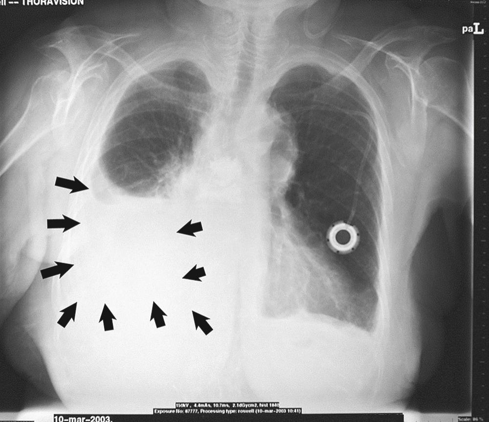 FIGURE 30-1, Chest roentgenogram showing large right pleural effusion (outlined by arrows ).