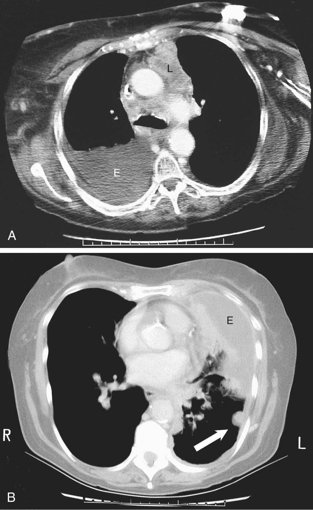 FIGURE 30-2, A, CT images of a malignant pleural effusion. B, Chest CT from a patient with breast carcinoma, with recurrent basilar left pleural effusion after partially successful chemical sclerosis. The image shows partial pleurodesis, pleural thickening, and a pleural nodule (arrow) at the level of the mid thorax. E, Effusion; L, prevascular lymphadenopathy.