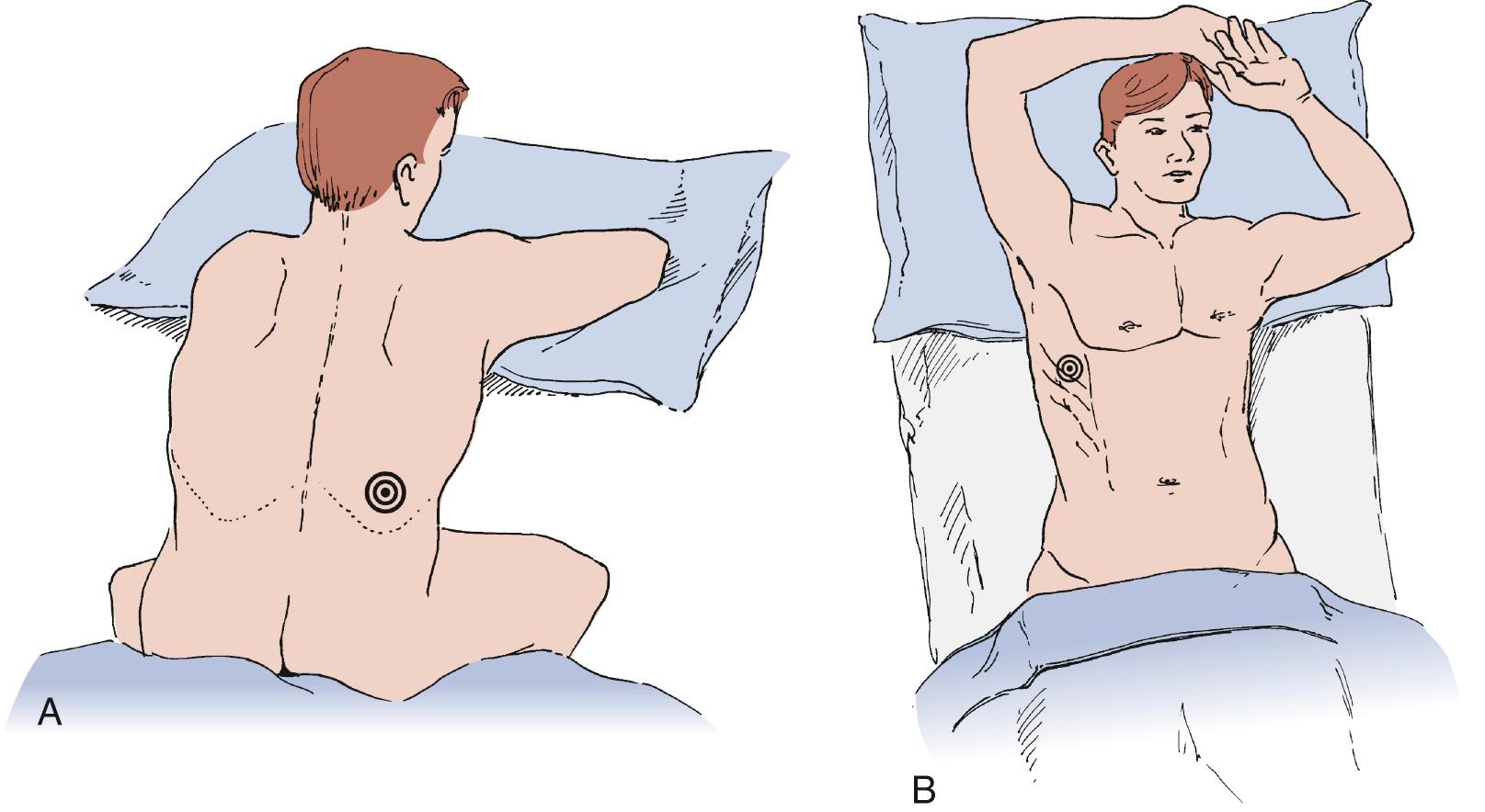 FIGURE 30-4, A, Common patient position for insertion of a thoracentesis needle or catheter. Posterior approach allows access to the most dependent (posterior pleural) sulcus to allow maximal drainage of nonloculated fluid. B, Lateral patient positioning for thoracentesis or chest tube placement is also useful for effusions with large lateral collections of fluid. The patient's arm is abducted and flexed over his head to facilitate access to the lateral chest.