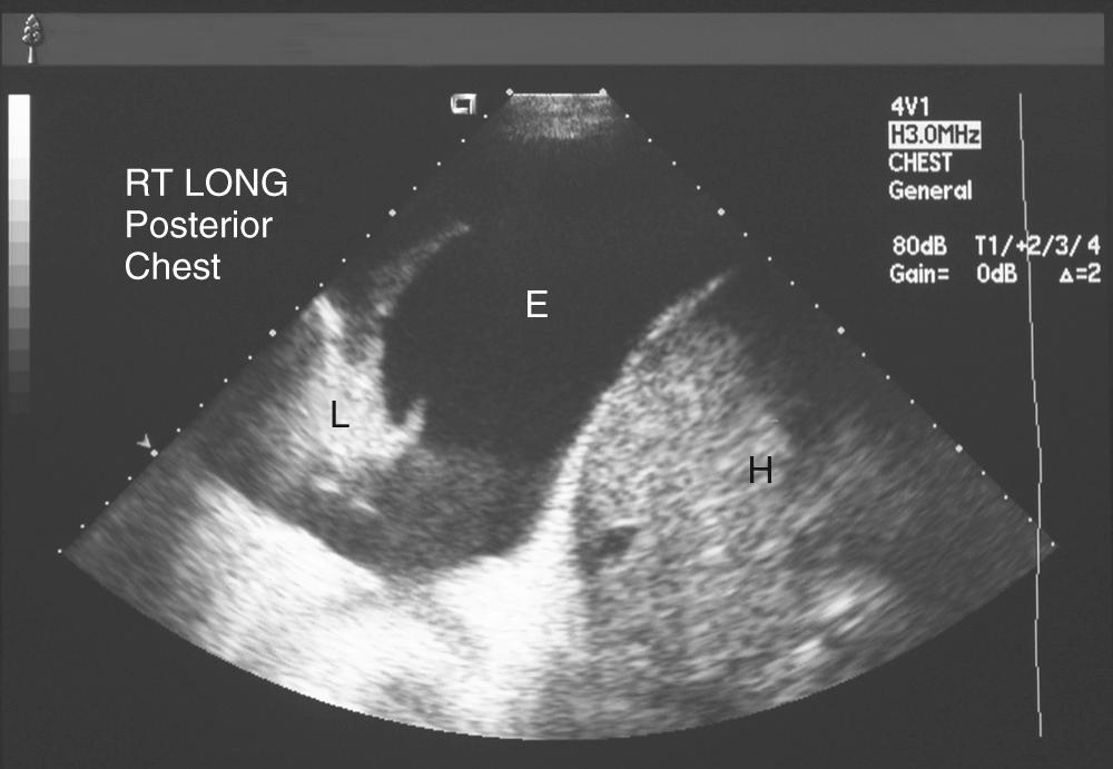 FIGURE 30-5, Ultrasound of right lateral chest to facilitate safe pleural access. E, Effusion; H, hepatic lobe; L, lung.