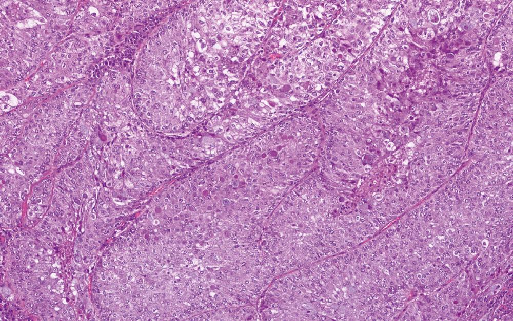 Fig. 45.3, Mucoepidermoid carcinoma. (H&E ×20)