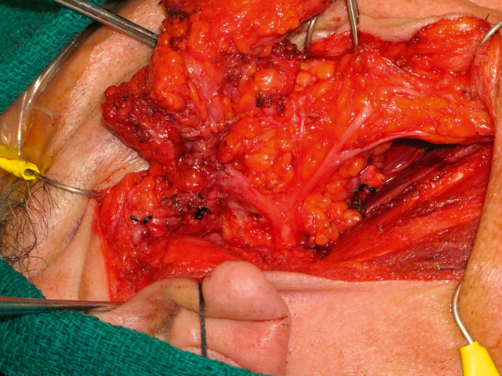 Fig. 47.1.1, Gross invasion of the upper division of the facial nerve.