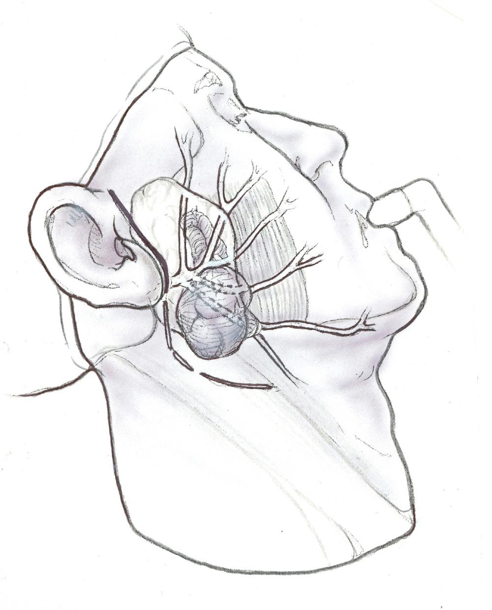 Fig. 47.1.2, Recurrent parotid gland tumor. Lower division branches are encased by the tumor.