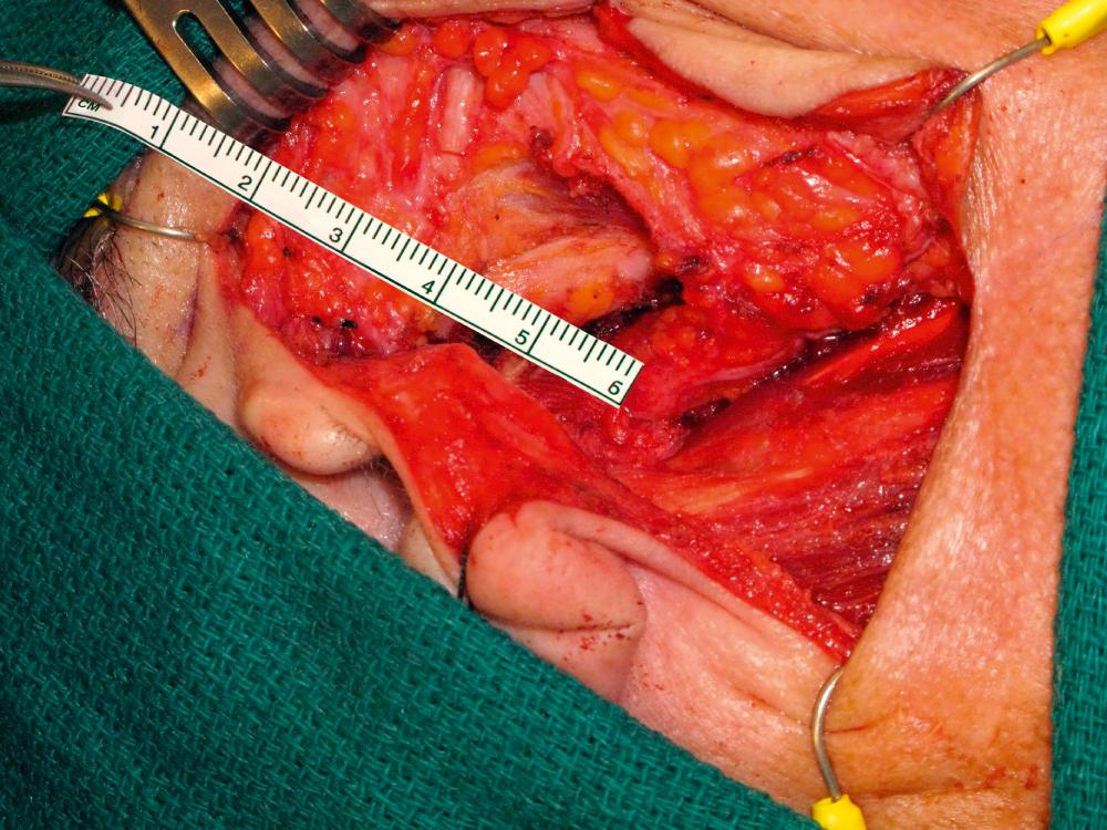 Fig. 47.1.3, Tumor resection with sacrifice of the upper division of the facial nerve is completed and stumps are prepared for nerve graft reconstruction.