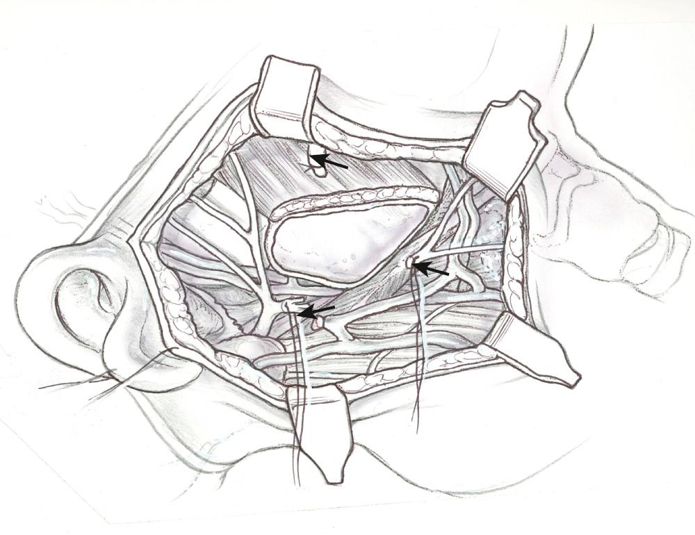 Fig. 47.1.4, Tumor resection is completed. The stumps of the lower division branches are identified for nerve graft procedure (arrows).