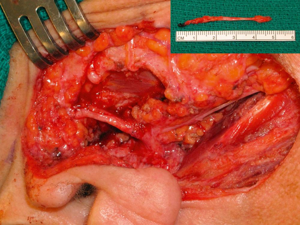 Fig. 47.1.5, Reconstruction of the upper division of the facial nerve using great auricular nerve graft (size shown in inset).