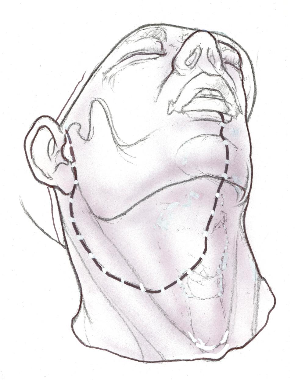 Fig. 47.1.6, Lower cheek flap incision extended toward the preauricular area.