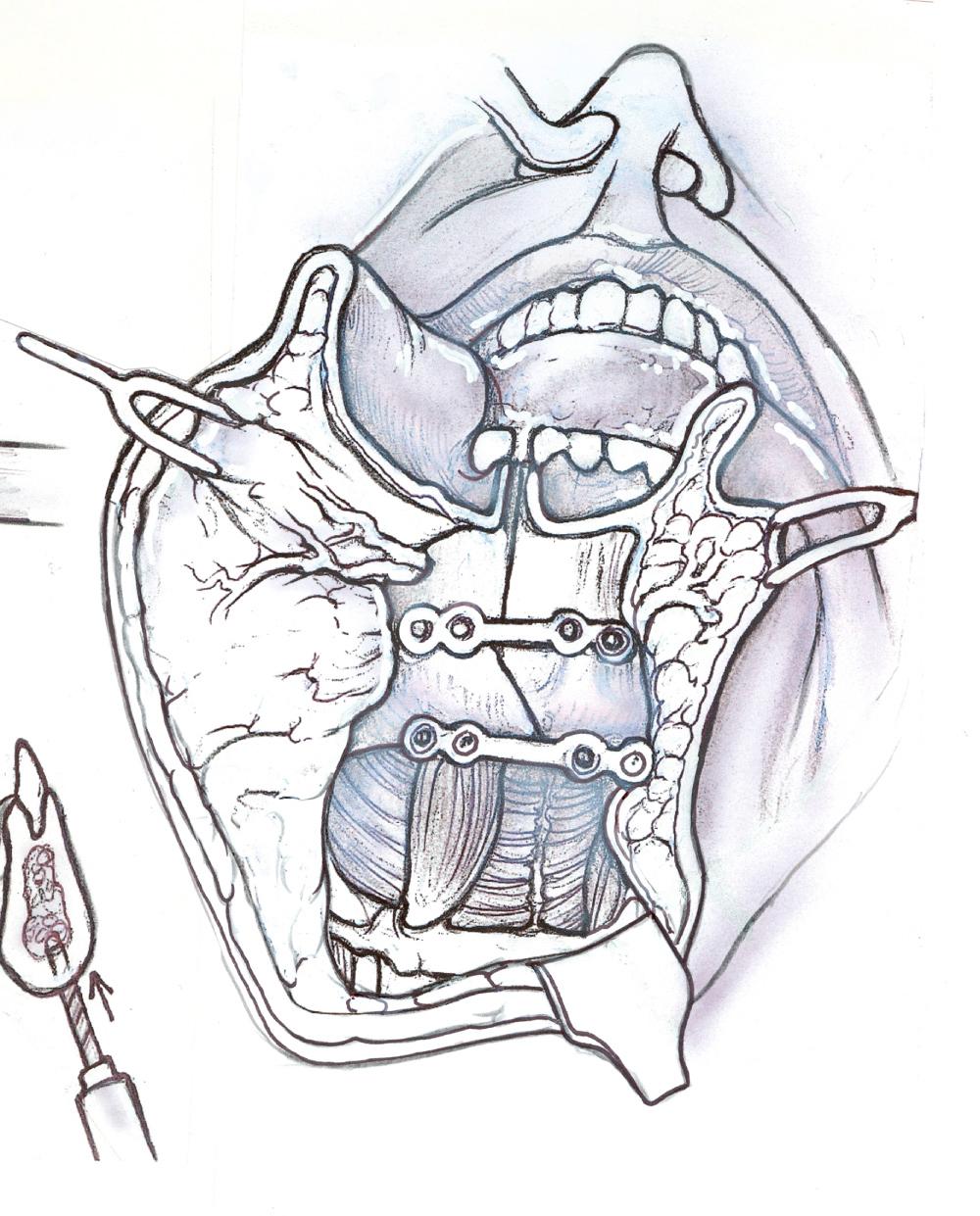 Fig. 47.1.7, Titanium miniplates are positioned prior to the osteotomy.