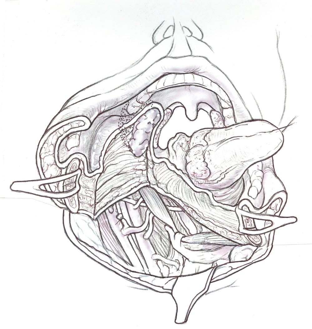 Fig. 47.1.10, Retraction of the mandibular segments after mylohyoid muscle is sectioned providing good exposure of the parapharyngeal space.