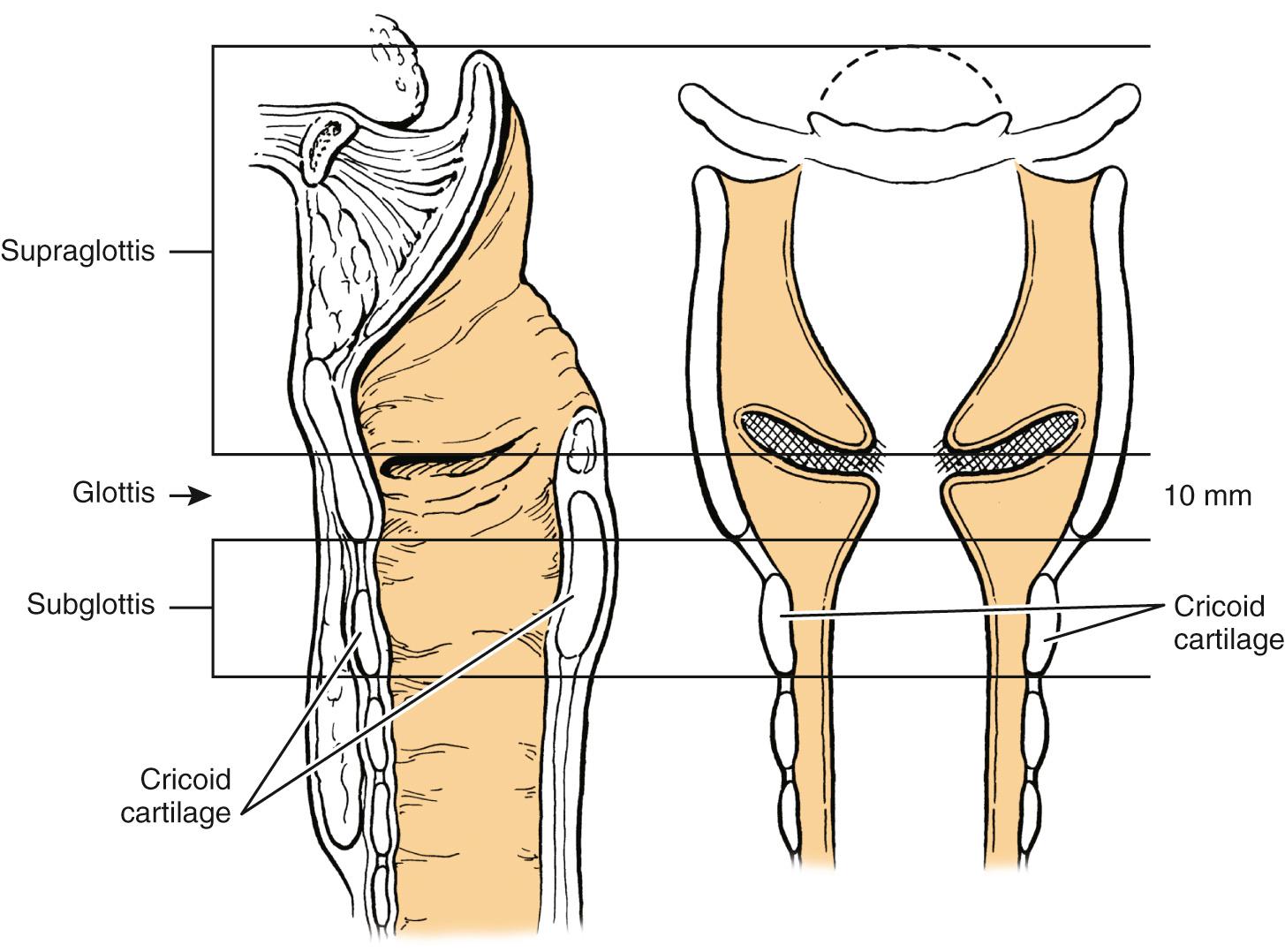 Fig. 105.1, Classification of laryngeal lesions by the anatomic site involved.