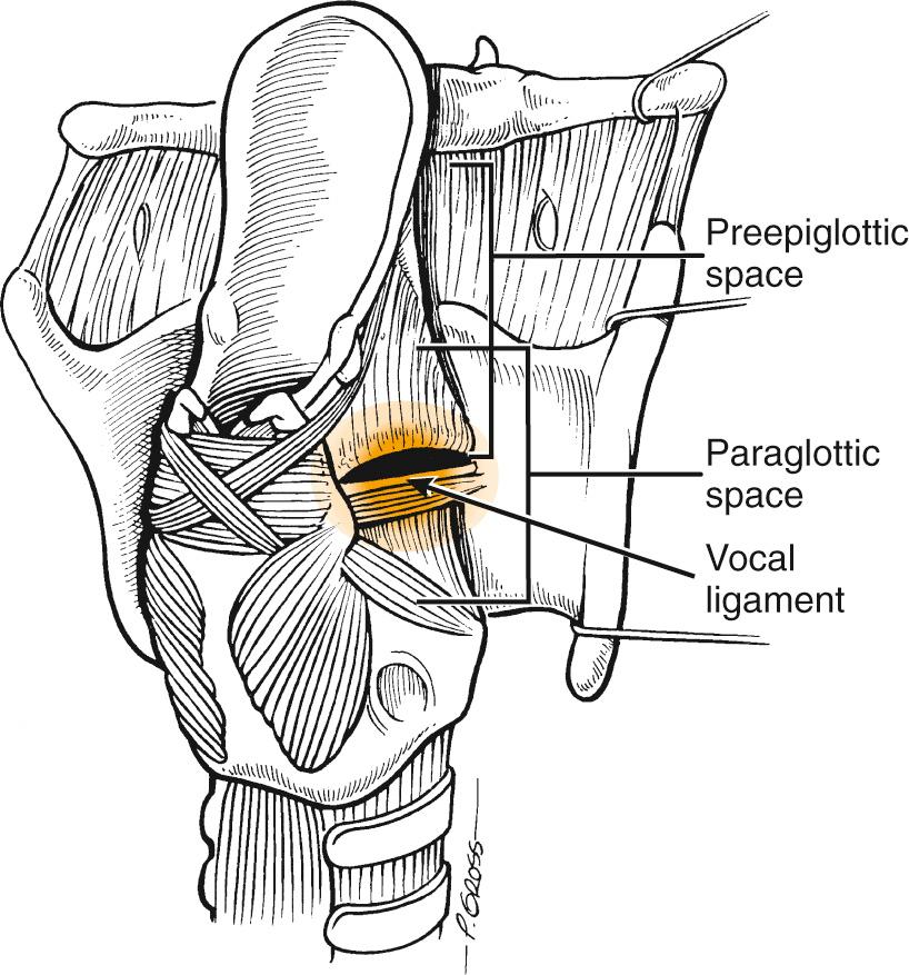 Fig. 105.2, Posterior oblique view of larynx showing confluence of preepiglottic and paraglottic spaces.