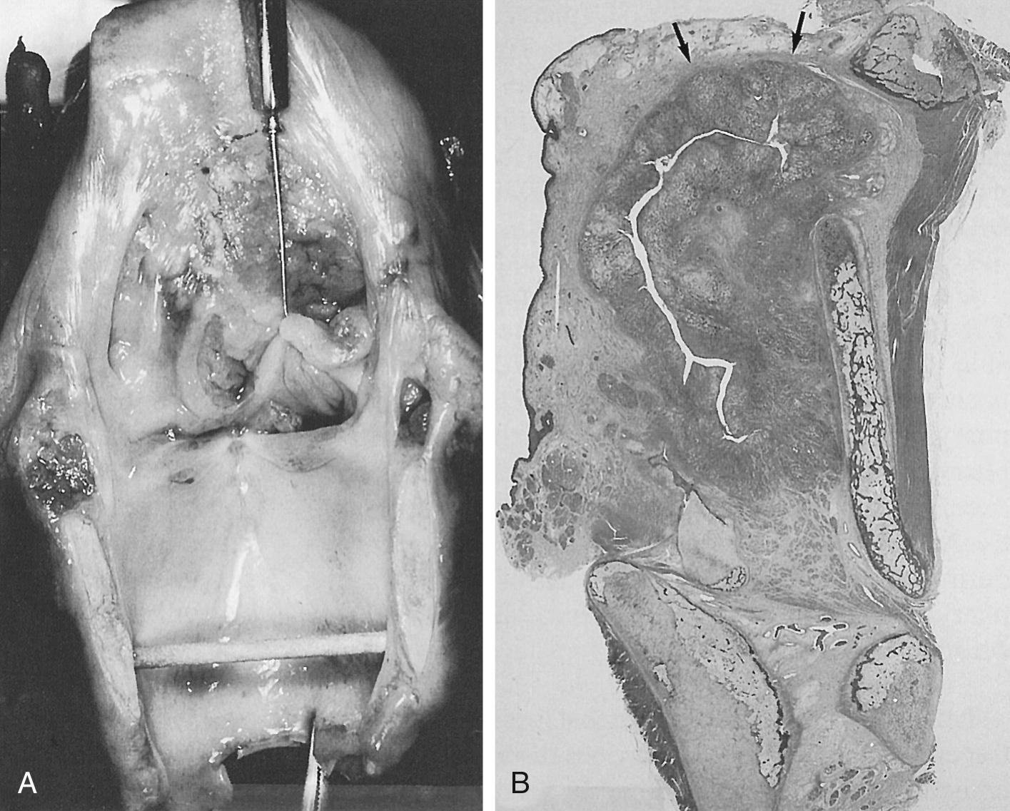 Fig. 105.3, (A) Total laryngectomy specimen with a deeply invasive supraglottic carcinoma arising from the false vocal cord. (B) Sagittal section shows cancer filling the paraglottic space without penetrating the hyoepiglottic ligament (arrows).