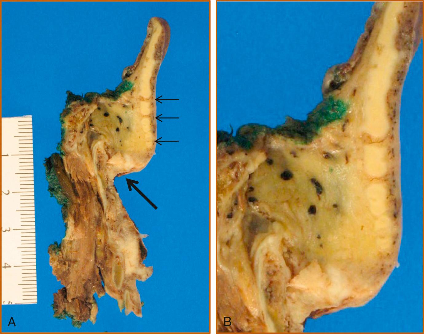 Fig. 105.4, (A) Carcinoma on the laryngeal surface of the infrahyoid epiglottis with invasion into the preepiglottic space (large arrow) . Note foramina in epiglottic cartilage (small arrows) . (B) Close-up demonstrating destruction of epiglottis and tumor transgression of foramina inferiorly.