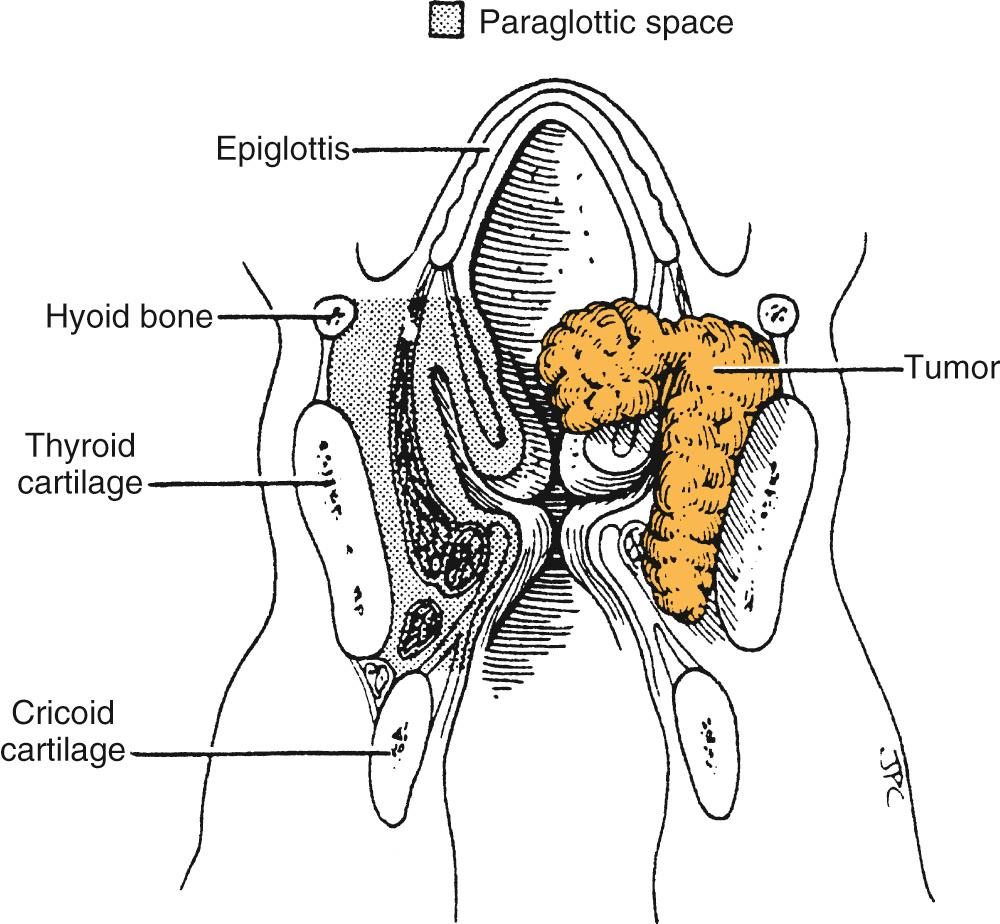 Fig. 105.5, Dimensions of the paraglottic space located between the mucosa of the larynx and its cartilaginous framework.