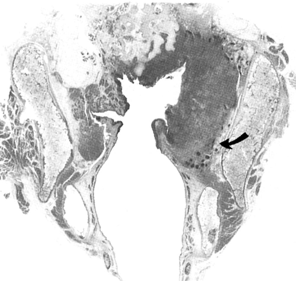 Fig. 105.6, This T3 supraglottic carcinoma extended to the glottis through the paraglottic space. Note the extension below the floor of the ventricle (arrow) with widening of the paraglottic space (hematoxylin-eosin, gross coronal section).