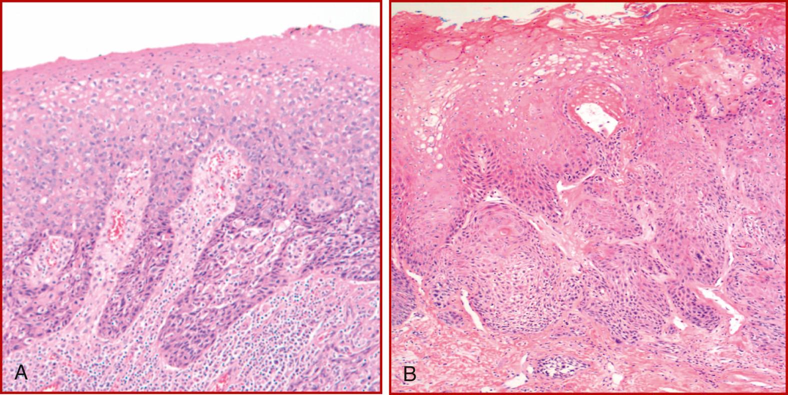 Fig. 105.7, (A) Carcinoma in situ. (B) Microinvasive carcinoma with violation of basement membrane.